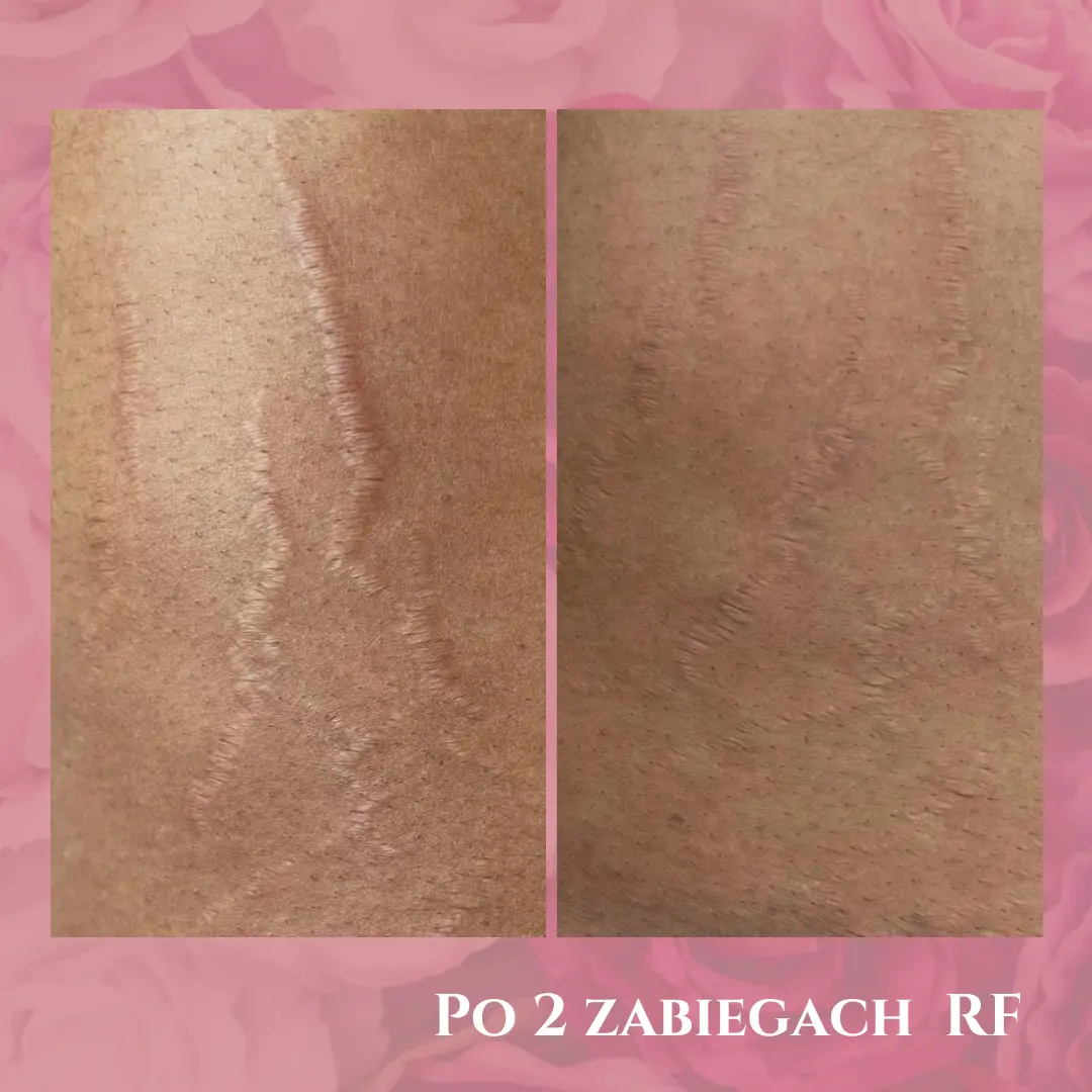 Rozstępy na ramieniu — efekt po dwóch zabiegach RF